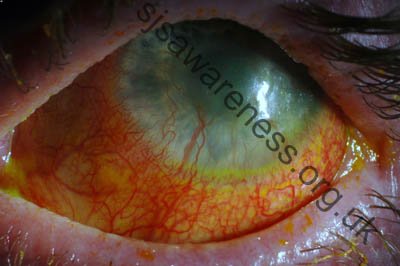 Left Eye - 24 year old male who suffered Toxic Epidermal Necrolysis Syndrome with severe Ocular involvement. Photo was taken 2 years after the initial TEN reaction